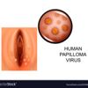 Papilomavirusul uman