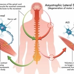 Esclerosis lateral amiotrófica