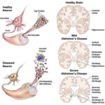 Malattia di Alzheimer