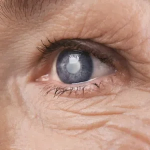cataractă