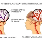 Accident vascular cerebral
