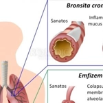 Bronhopneumopatie obstructivă cronică